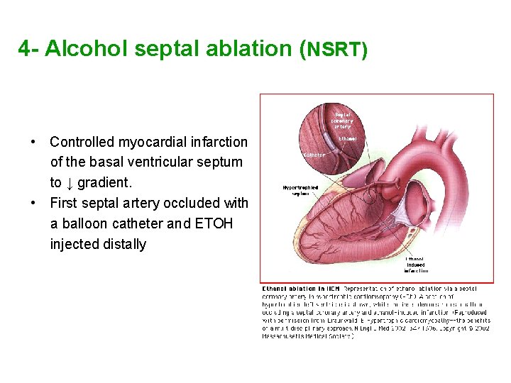 4 - Alcohol septal ablation (NSRT) • Controlled myocardial infarction of the basal ventricular