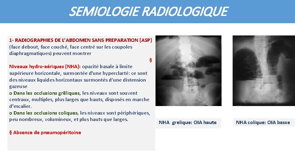 SEMIOLOGIE RADIOLOGIQUE 1 - RADIOGRAPHIES DE L’ABDOMEN SANS PREPARATION (ASP) (face debout, face couché,