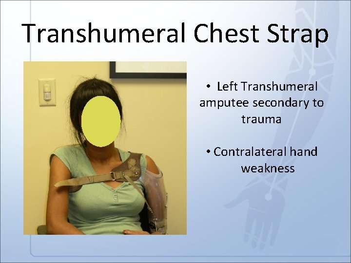 Transhumeral Chest Strap • Left Transhumeral amputee secondary to trauma • Contralateral hand weakness