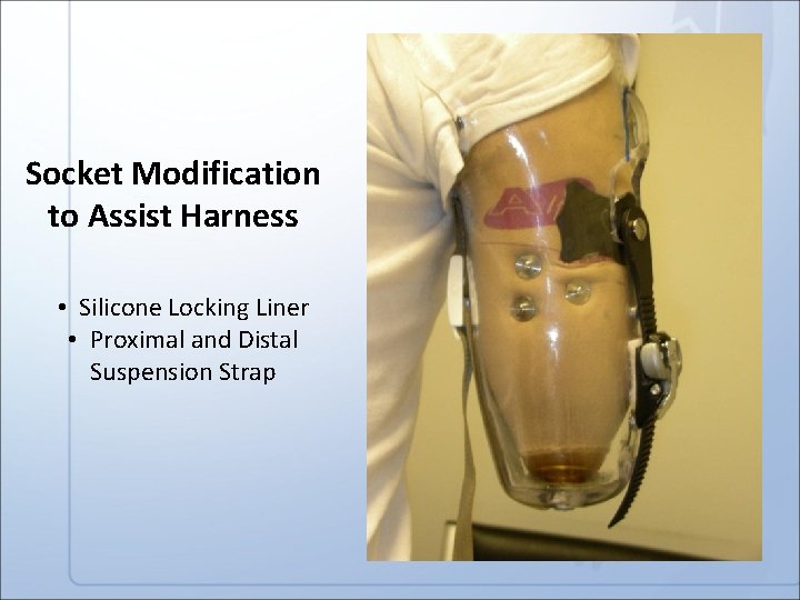 Socket Modification to Assist Harness • Silicone Locking Liner • Proximal and Distal Suspension