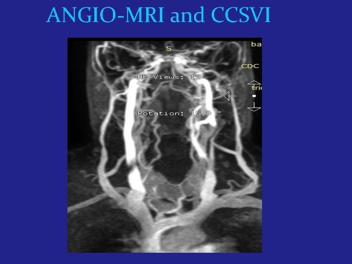ANGIO-MRI and CCSVI 