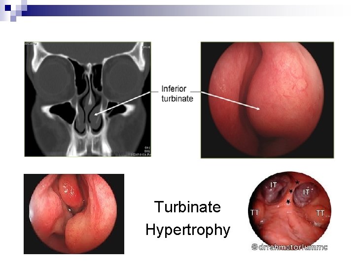 Turbinate Hypertrophy 