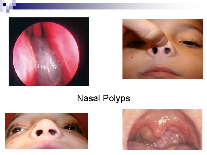 Nasal Polyps 