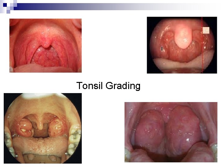  Tonsil Grading 