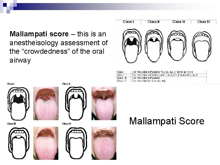 Mallampati score – this is an anestheisology assessment of the “crowdedness” of the oral