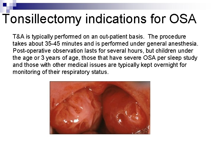 Tonsillectomy indications for OSA T&A is typically performed on an out-patient basis. The procedure