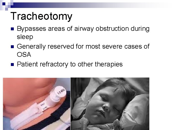 Tracheotomy n n n Bypasses areas of airway obstruction during sleep Generally reserved for