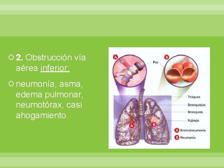  2. Obstrucción vía aérea inferior: neumonía, asma, edema pulmonar, neumotórax, casi ahogamiento. 