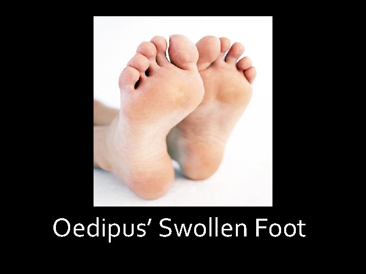 Oedipus’ Swollen Foot 