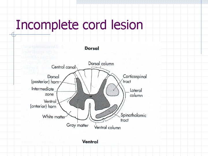 Incomplete cord lesion 