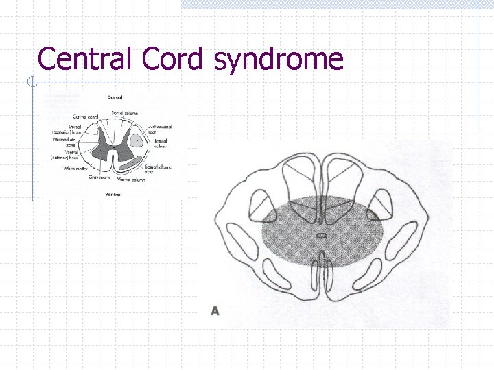 Central Cord syndrome 