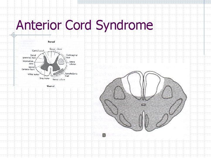 Anterior Cord Syndrome 