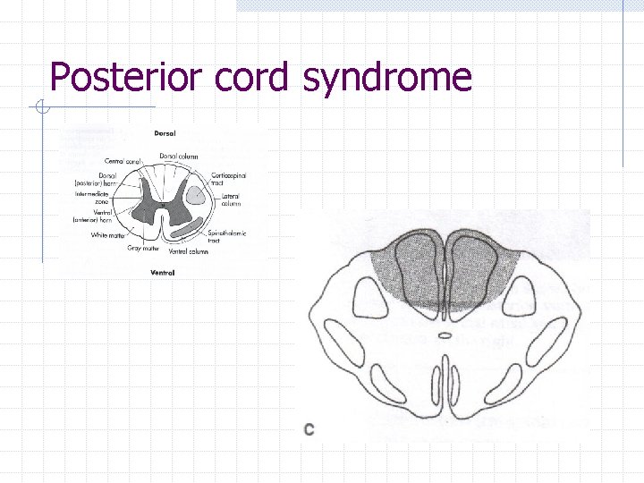 Posterior cord syndrome 