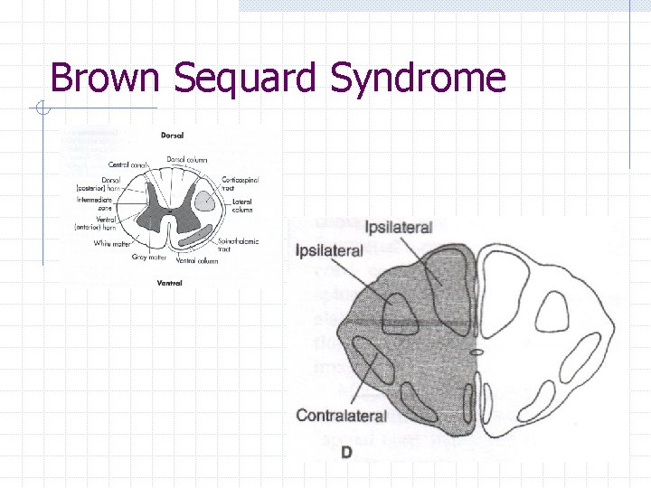 Brown Sequard Syndrome 