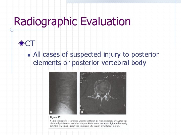 Radiographic Evaluation CT n All cases of suspected injury to posterior elements or posterior