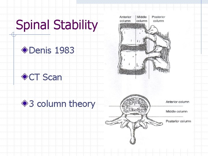 Spinal Stability Denis 1983 CT Scan 3 column theory 