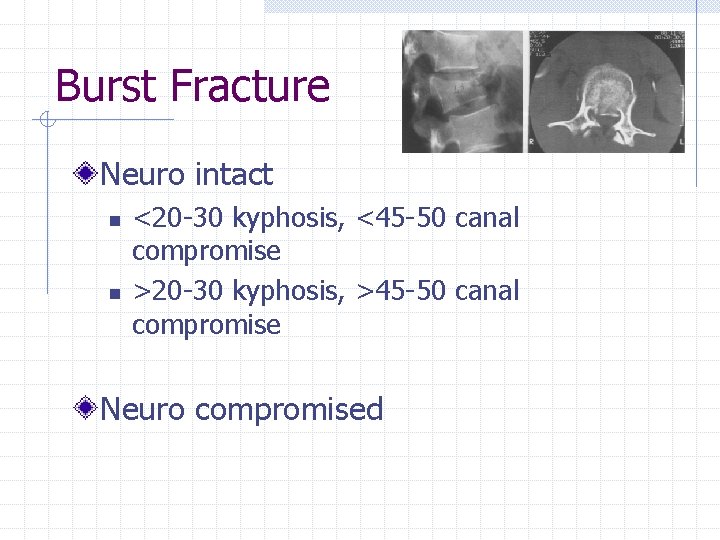 Burst Fracture Neuro intact n n <20 -30 kyphosis, <45 -50 canal compromise >20