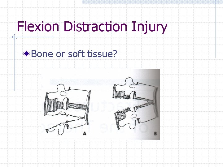 Flexion Distraction Injury Bone or soft tissue? 