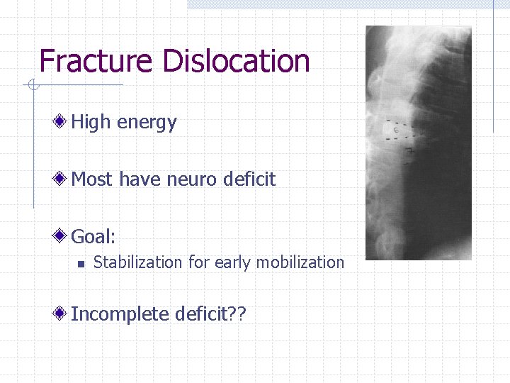 Fracture Dislocation High energy Most have neuro deficit Goal: n Stabilization for early mobilization