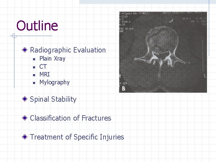 Outline Radiographic Evaluation n n Plain Xray CT MRI Mylography Spinal Stability Classification of