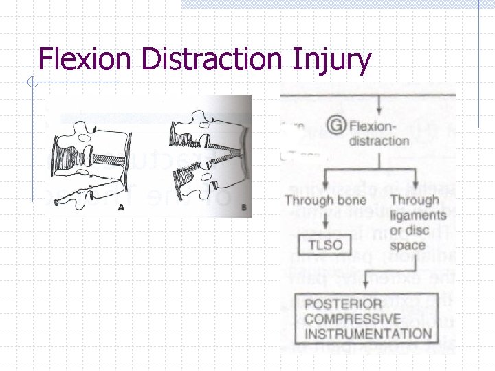 Flexion Distraction Injury 