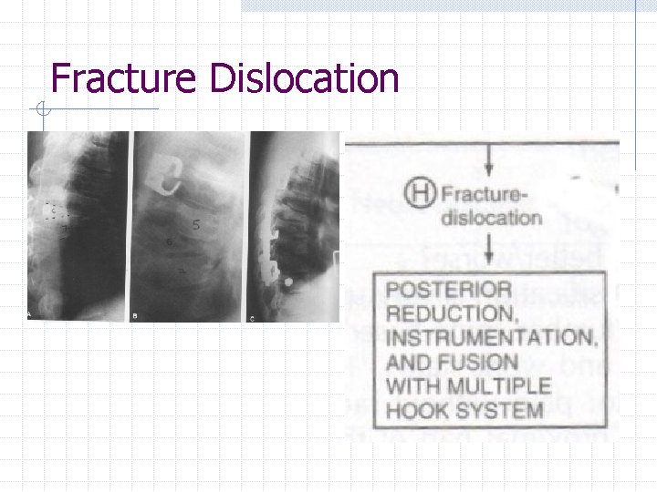 Fracture Dislocation 