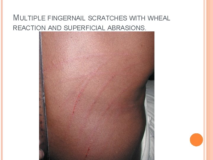 MULTIPLE FINGERNAIL SCRATCHES WITH WHEAL REACTION AND SUPERFICIAL ABRASIONS. 