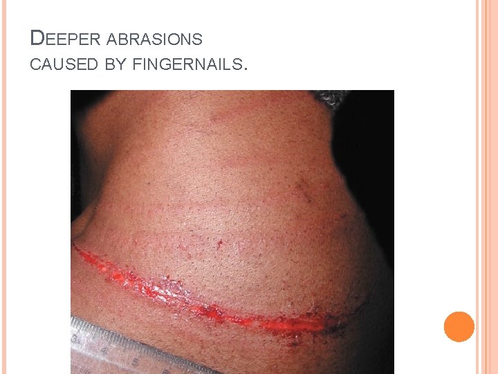 DEEPER ABRASIONS CAUSED BY FINGERNAILS. 