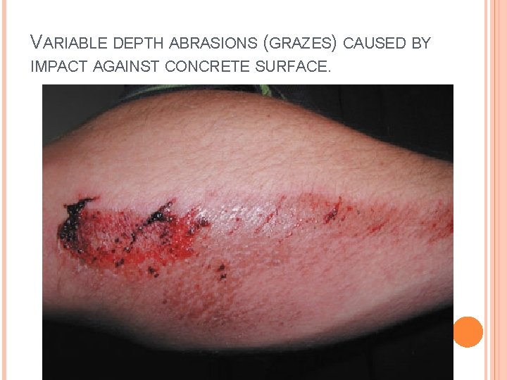 VARIABLE DEPTH ABRASIONS (GRAZES) CAUSED BY IMPACT AGAINST CONCRETE SURFACE. 