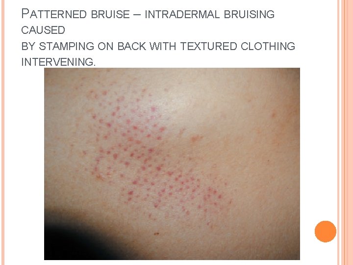 PATTERNED BRUISE – INTRADERMAL BRUISING CAUSED BY STAMPING ON BACK WITH TEXTURED CLOTHING INTERVENING.