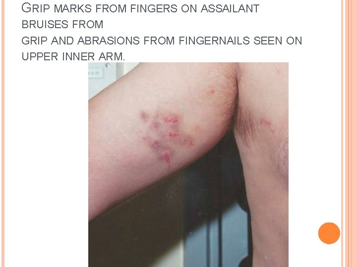 GRIP MARKS FROM FINGERS ON ASSAILANT BRUISES FROM GRIP AND ABRASIONS FROM FINGERNAILS SEEN