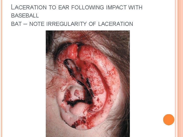 LACERATION TO EAR FOLLOWING IMPACT WITH BASEBALL BAT – NOTE IRREGULARITY OF LACERATION 