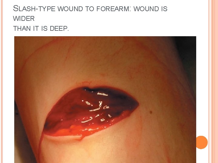 SLASH-TYPE WOUND TO FOREARM: WOUND IS WIDER THAN IT IS DEEP. 