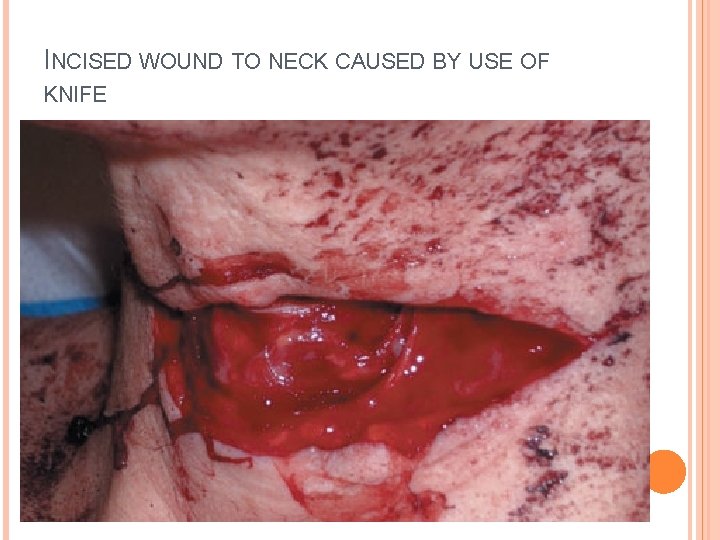 INCISED WOUND TO NECK CAUSED BY USE OF KNIFE 