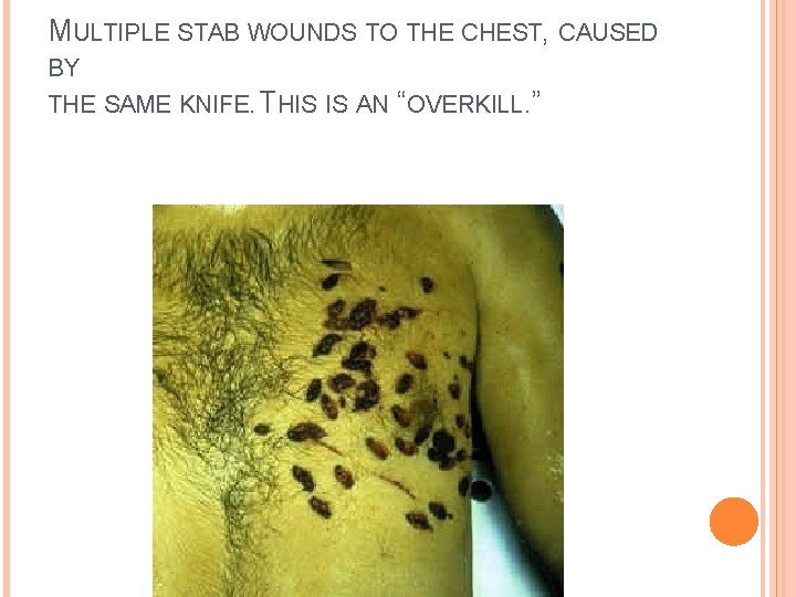 MULTIPLE STAB WOUNDS TO THE CHEST, CAUSED BY THE SAME KNIFE. THIS IS AN