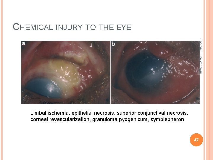 CHEMICAL INJURY TO THE EYE 1: 02 PM Dr. SV. Patil Limbal ischemia, epithelial