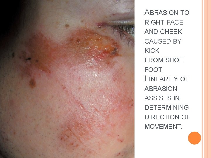 ABRASION TO RIGHT FACE AND CHEEK CAUSED BY KICK FROM SHOE FOOT. LINEARITY OF