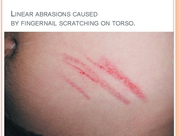 LINEAR ABRASIONS CAUSED BY FINGERNAIL SCRATCHING ON TORSO. 