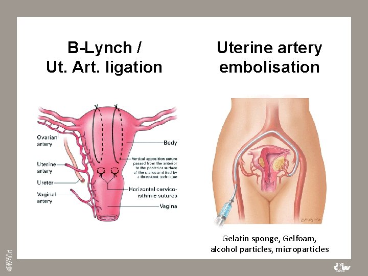 B-Lynch / Ut. Art. ligation Uterine artery embolisation Gelatin sponge, Gelfoam, alcohol particles, microparticles