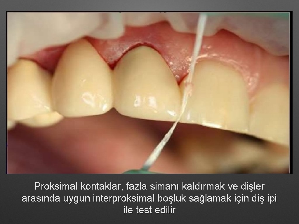 Proksimal kontaklar, fazla simanı kaldırmak ve dişler arasında uygun interproksimal boşluk sağlamak için diş