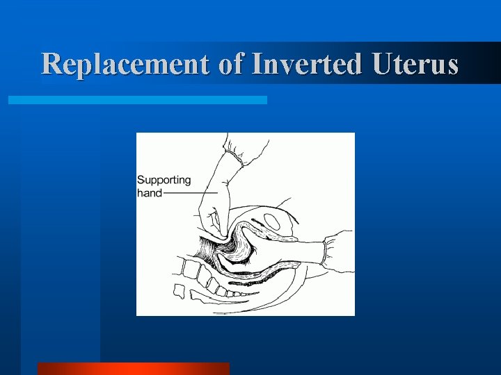 Replacement of Inverted Uterus 