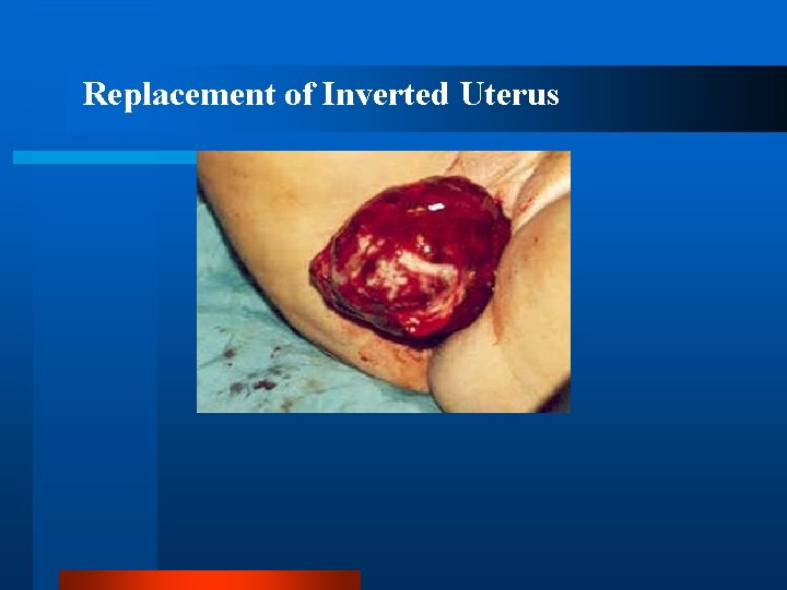 Replacement of Inverted Uterus 