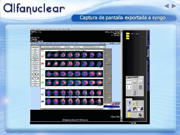 Captura de pantalla exportada a syngo 