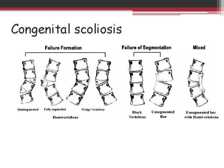 Congenital scoliosis Treatment is surgical • 