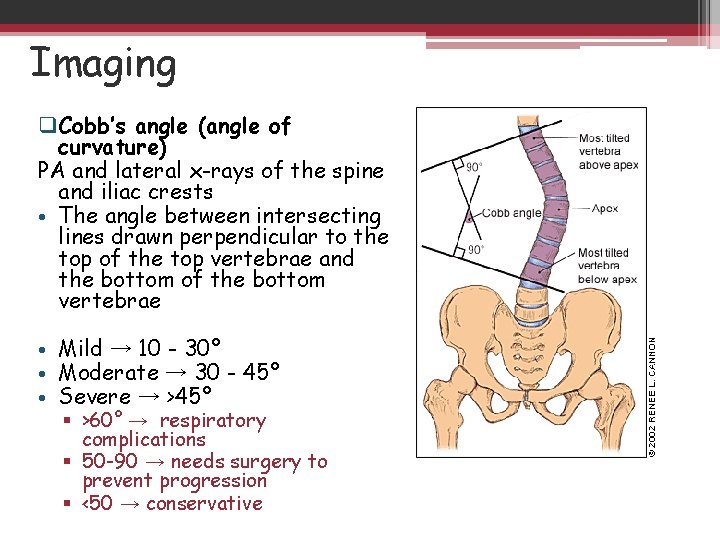 Imaging q. Cobb’s angle (angle of curvature) PA and lateral x-rays of the spine