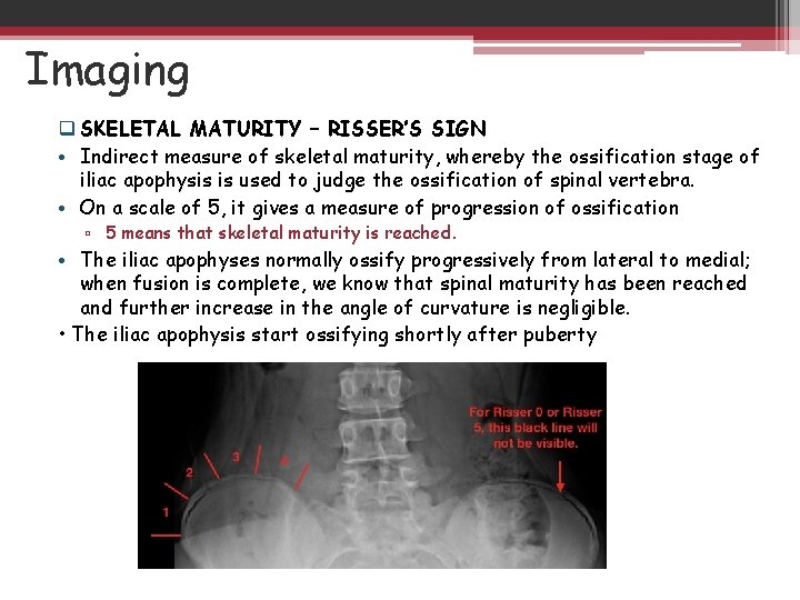 Imaging q SKELETAL MATURITY – RISSER’S SIGN • Indirect measure of skeletal maturity, whereby