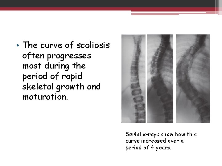  • The curve of scoliosis often progresses most during the period of rapid