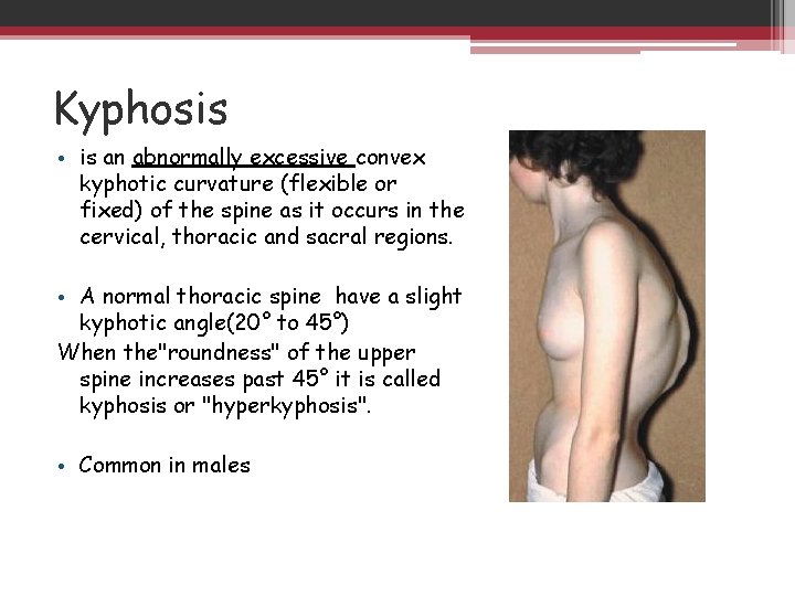 Kyphosis • is an abnormally excessive convex kyphotic curvature (flexible or fixed) of the