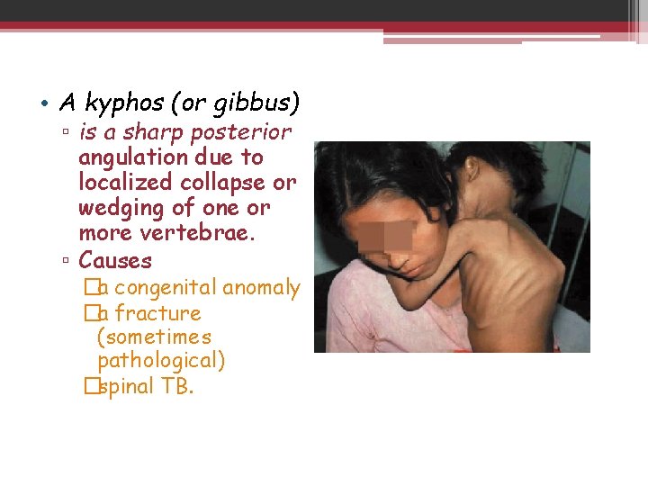  • A kyphos (or gibbus) ▫ is a sharp posterior angulation due to