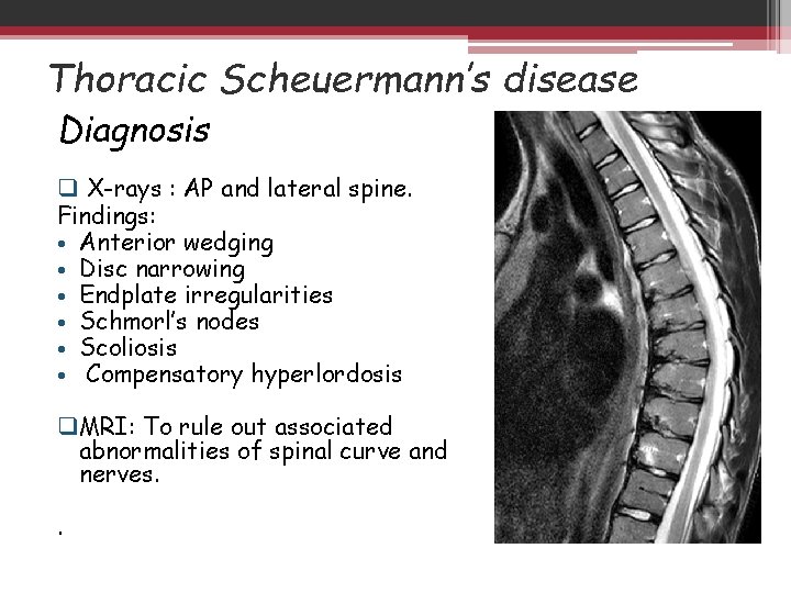 Thoracic Scheuermann’s disease Diagnosis q X-rays : AP and lateral spine. Findings: • Anterior